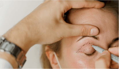 Eyelid Lift